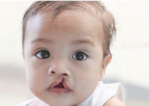 Is Abortion Right…for Cleft Palate Reasons